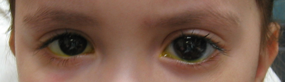 close up of young girl with glaucoma